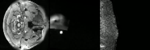 Low Resolution MRI